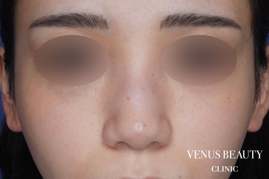 骨切幅寄せ 施術前