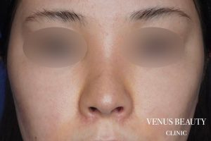 鼻翼縮小 施術後