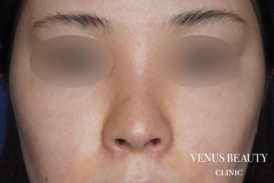 鼻翼縮小 施術後