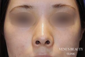 鼻翼縮小 施術前