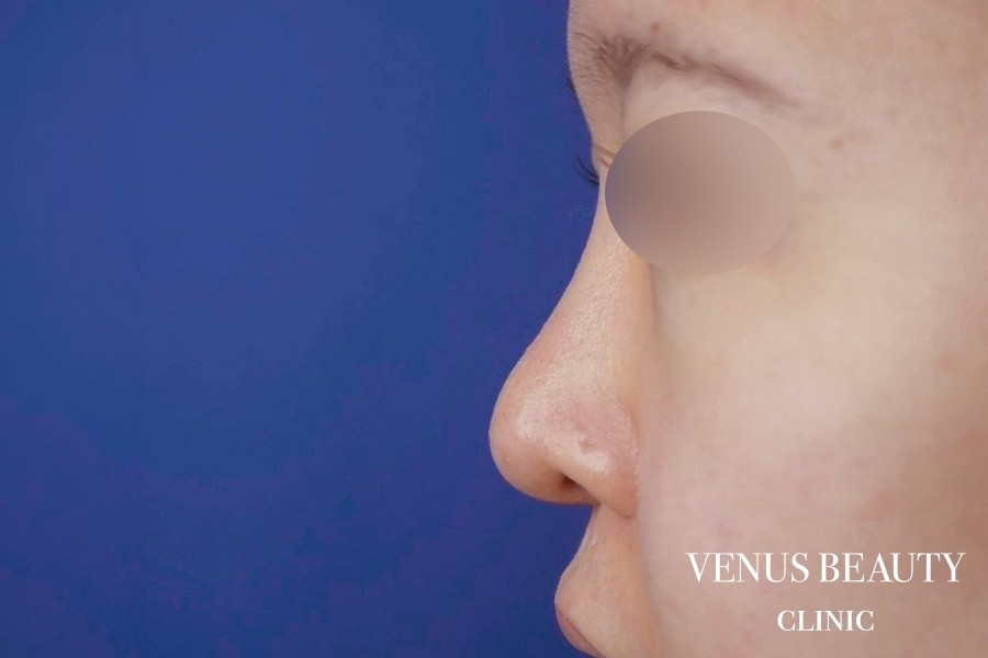 鼻中隔延長 施術後