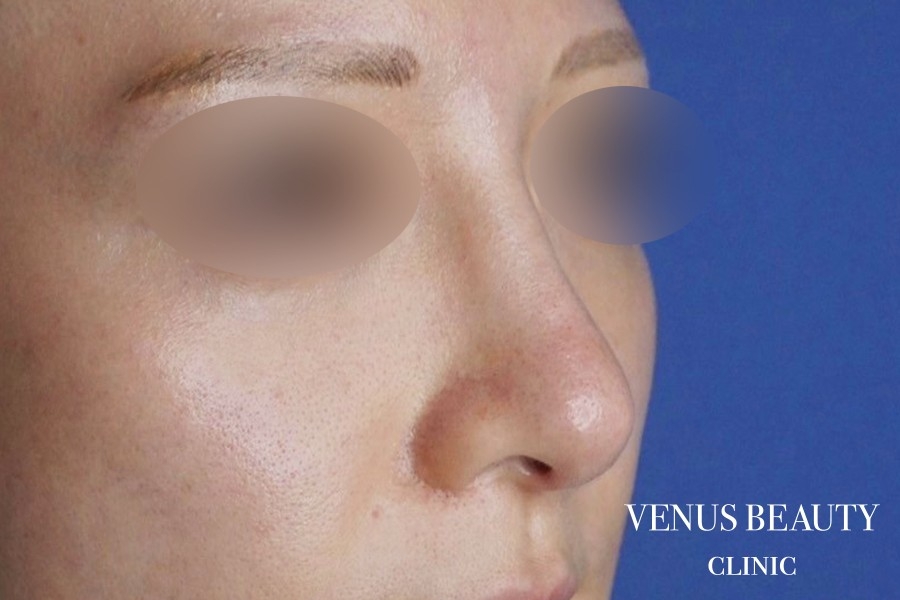 わし鼻・段鼻修正 ハンプ切除 施術後