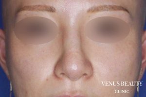 骨切幅寄せ 施術後