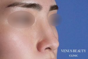 鼻尖形成 施術後