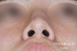 骨切幅寄せ 施術後