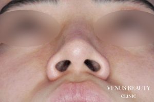 骨切幅寄せ 施術前