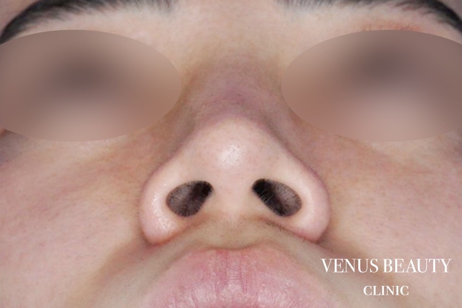 骨切幅寄せ 施術前