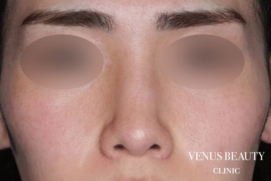 骨切幅寄せ 施術後