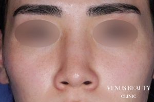 鼻尖形成 施術前