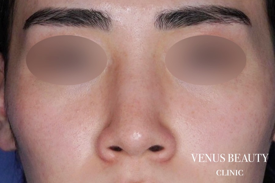 骨切幅寄せ 施術前