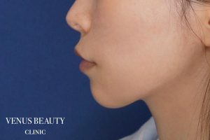 糸リフト＋脂肪吸引 施術後