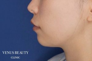 糸リフト＋脂肪吸引 施術前