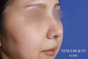 鼻中隔延長 施術後