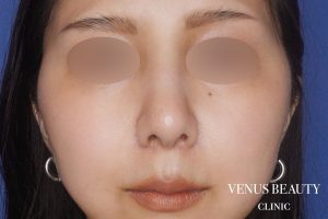 鼻翼縮小 施術後