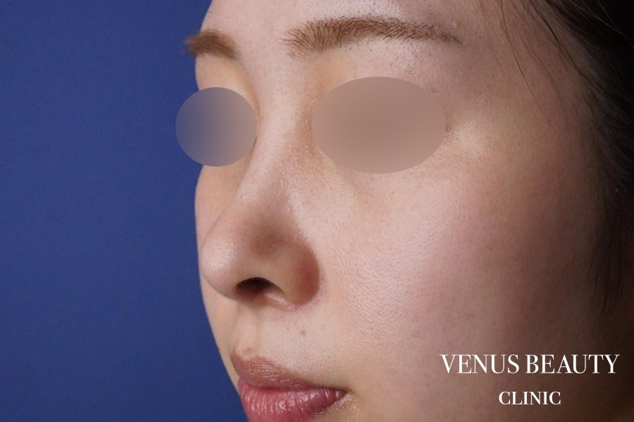 鼻中隔延長 施術後