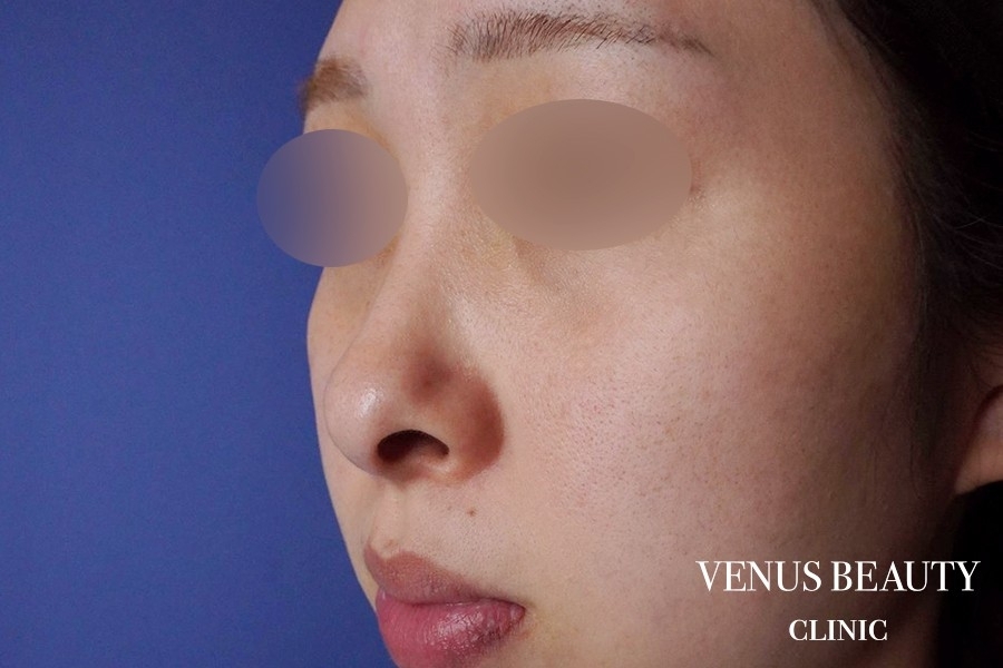 鼻中隔延長 施術前