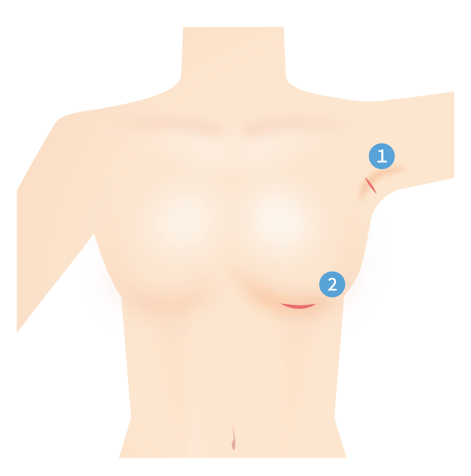切開箇所〜シリコン豊胸