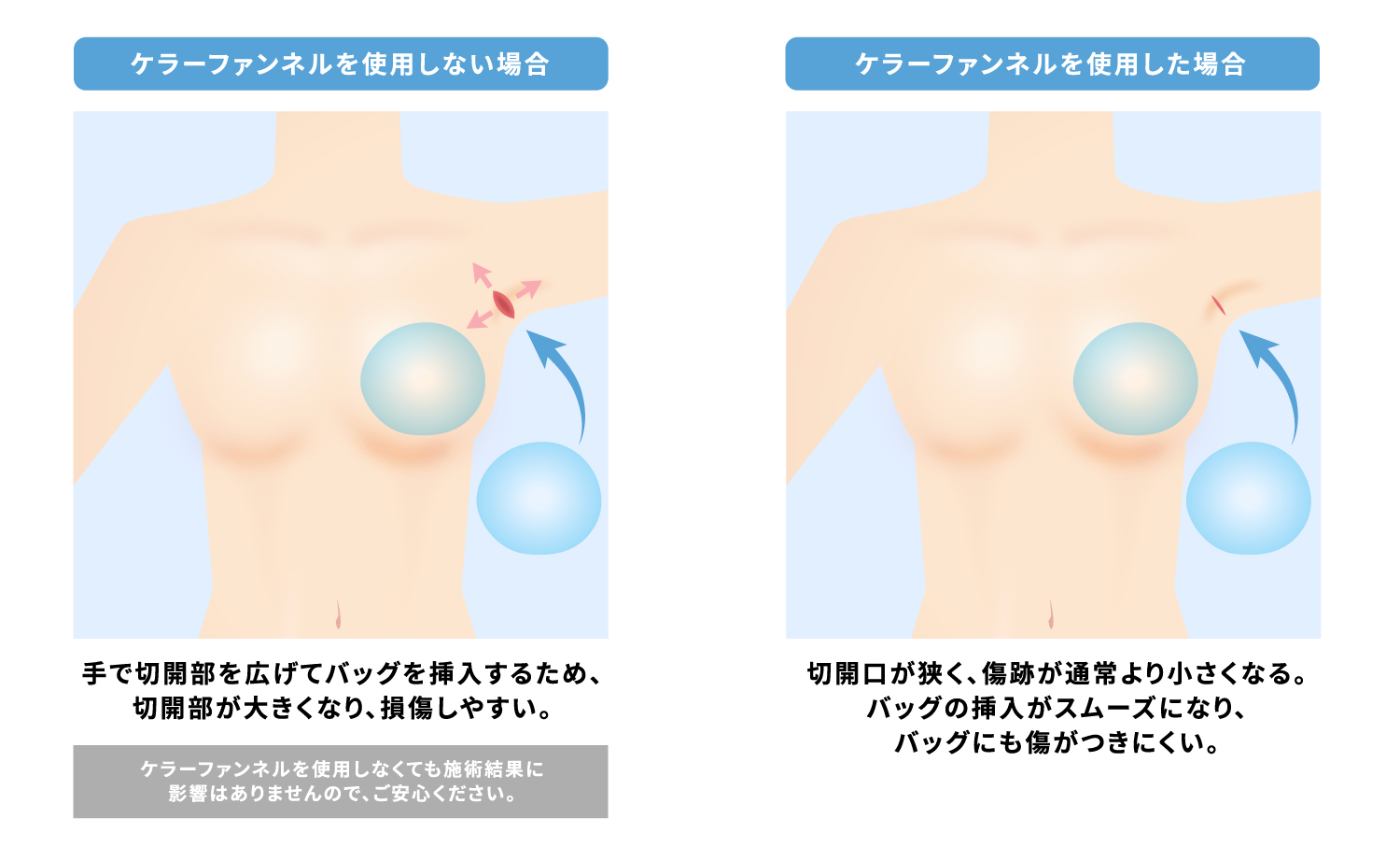 ケラーファンネル〜脂肪豊胸
