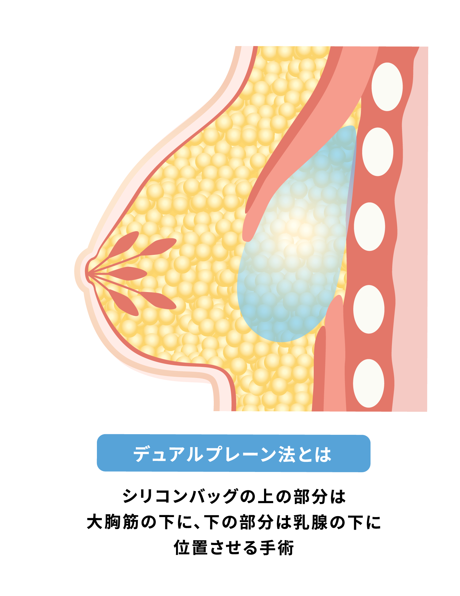 デュアルプレーン法〜シリコン豊胸