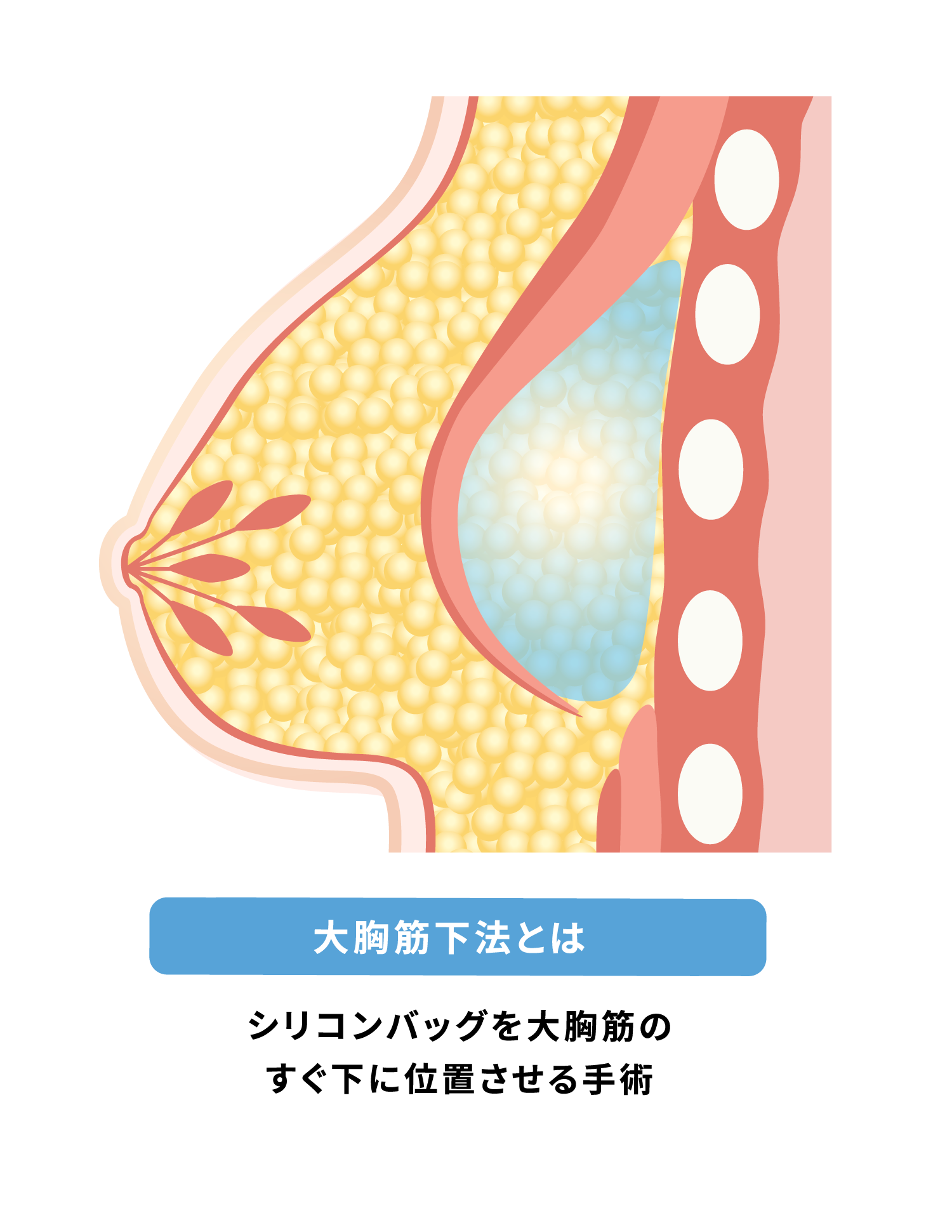 大胸筋下法〜シリコン豊胸
