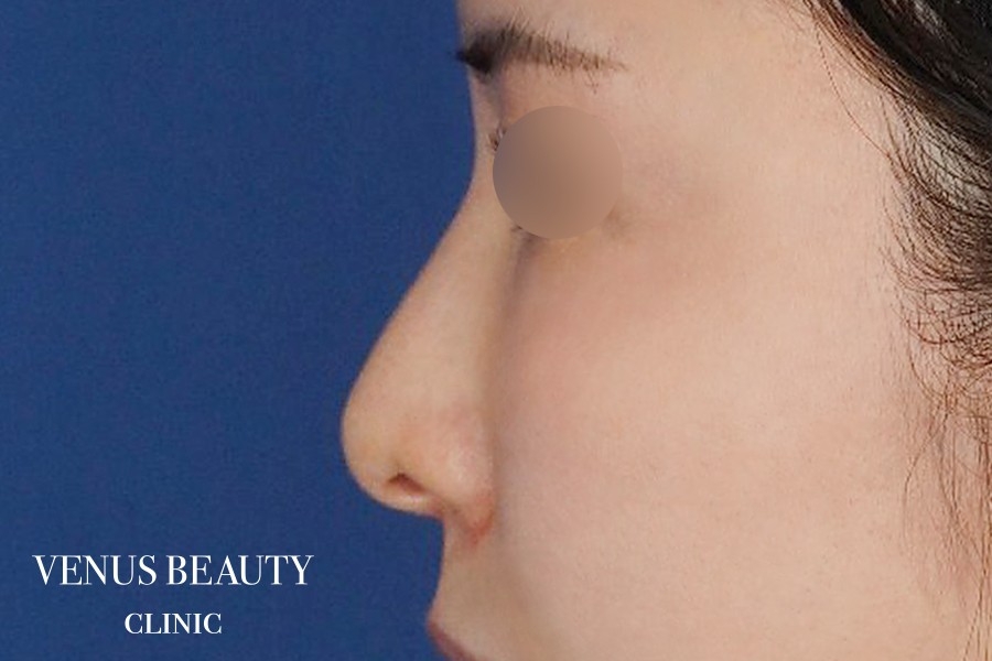 わし鼻・段鼻修正 ハンプ切除 施術後