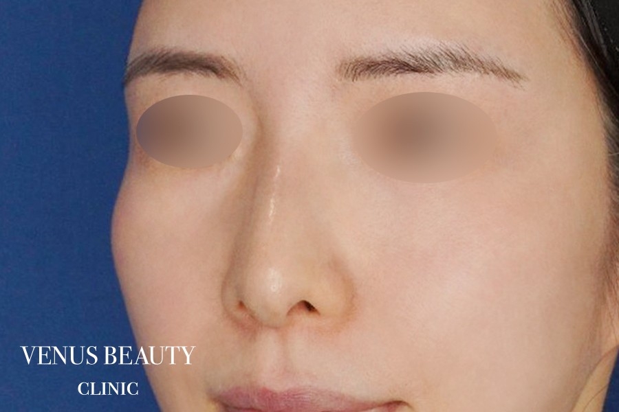 わし鼻・段鼻修正 ハンプ切除 施術後
