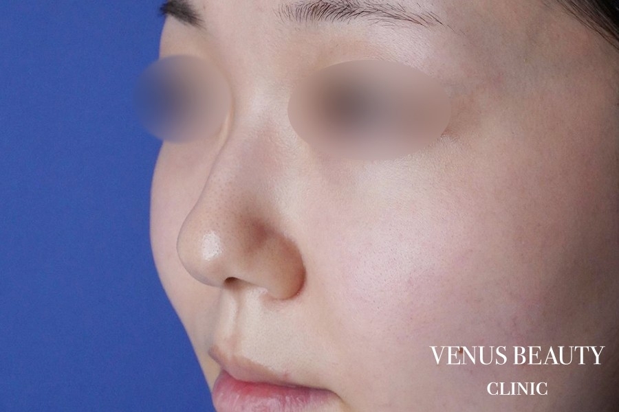 鼻翼縮小 施術前
