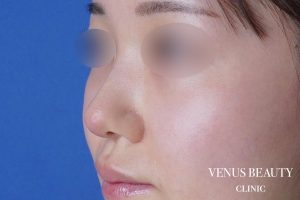 鼻尖形成 施術後