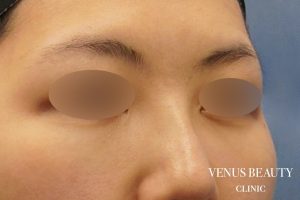 下まぶたのたるみとり 施術後