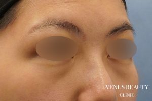 下まぶたのたるみとり 施術前