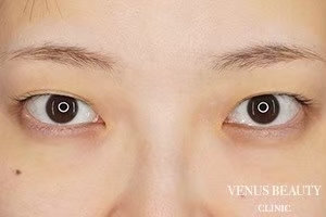 二重まぶた埋没法 施術前