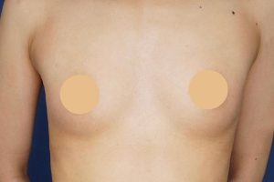 脂肪注入豊胸 施術後