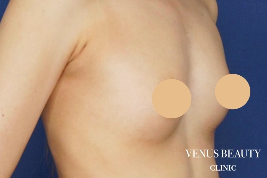 脂肪注入豊胸 施術後