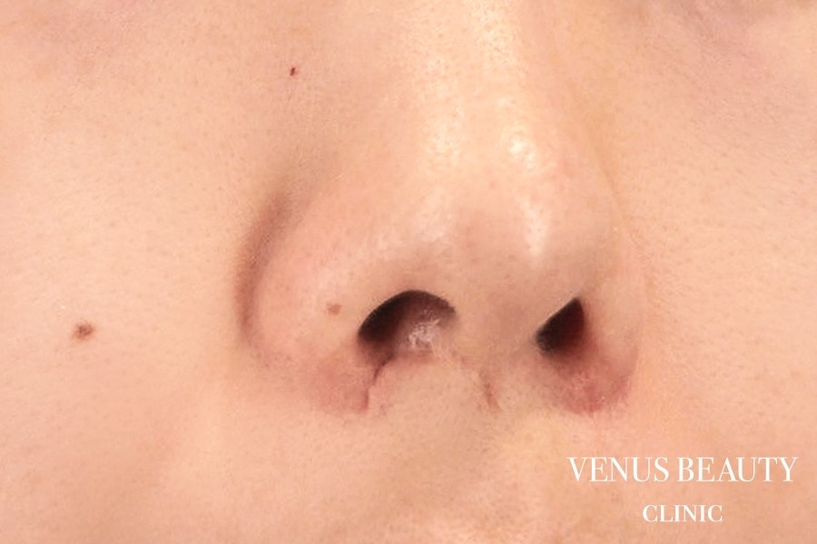 傷跡修正 施術前