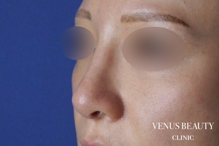 鼻尖形成 施術後