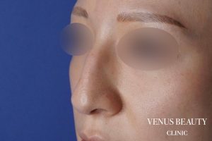 鼻尖形成 施術前