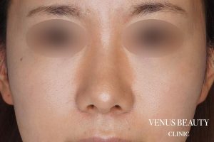 鼻尖形成 施術後