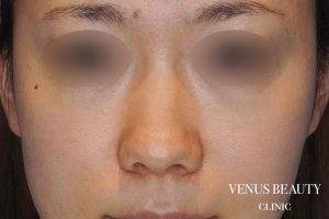 鼻尖形成 施術前