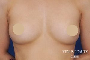 脂肪注入豊胸 施術後