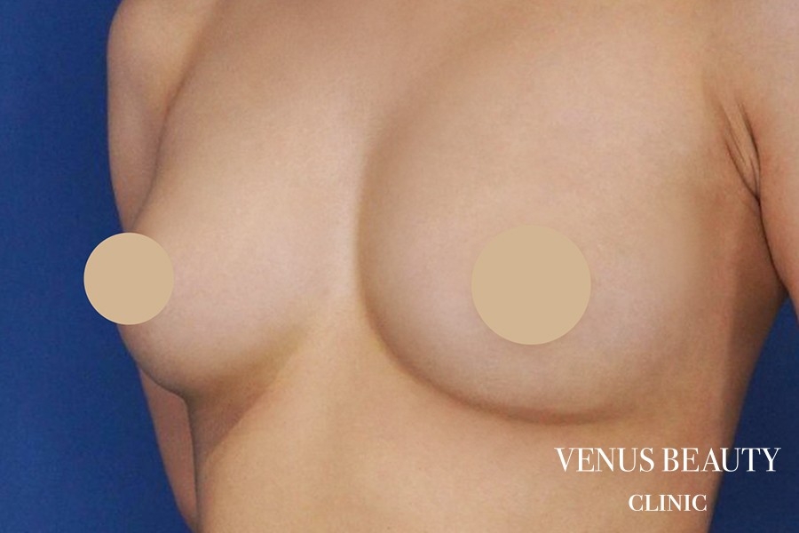 脂肪注入豊胸 施術後