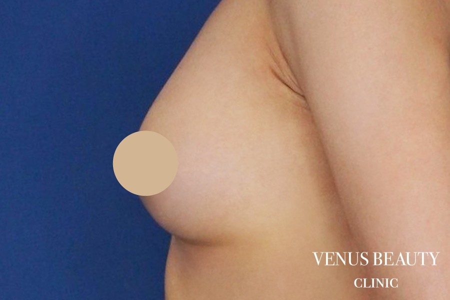 脂肪注入豊胸 施術後