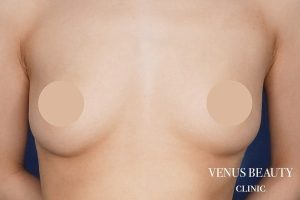 脂肪注入豊胸 施術前