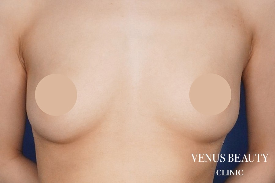 脂肪注入豊胸 施術前