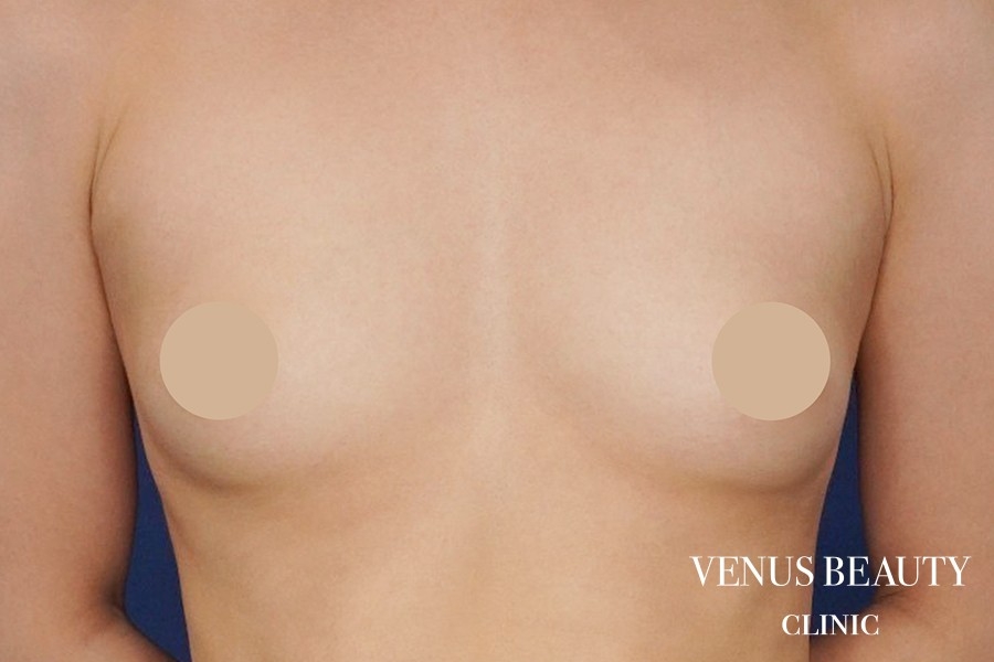 脂肪注入豊胸 施術前