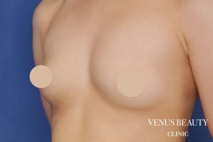 脂肪注入豊胸 施術前