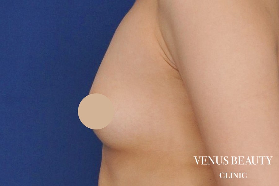 脂肪注入豊胸 施術前