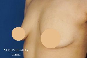 脂肪注入豊胸 施術前