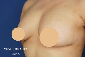 脂肪注入豊胸 施術後