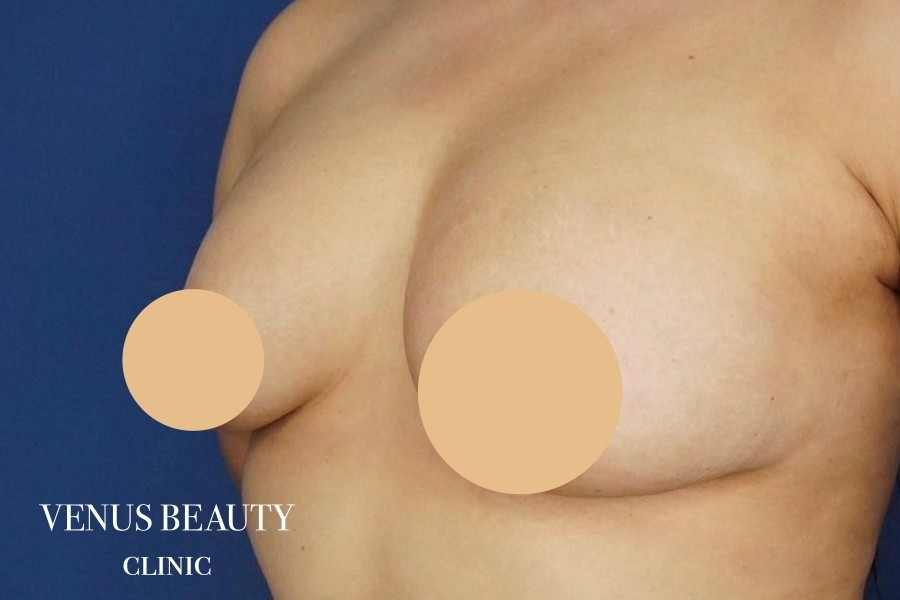 脂肪注入豊胸 施術後