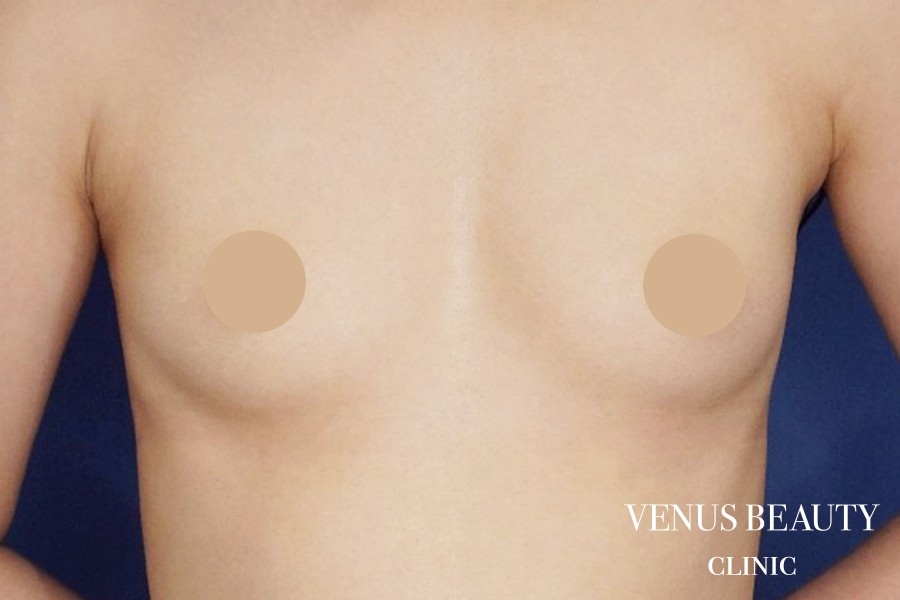 脂肪注入豊胸 施術前